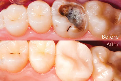 SafeEndo ReCreate LC