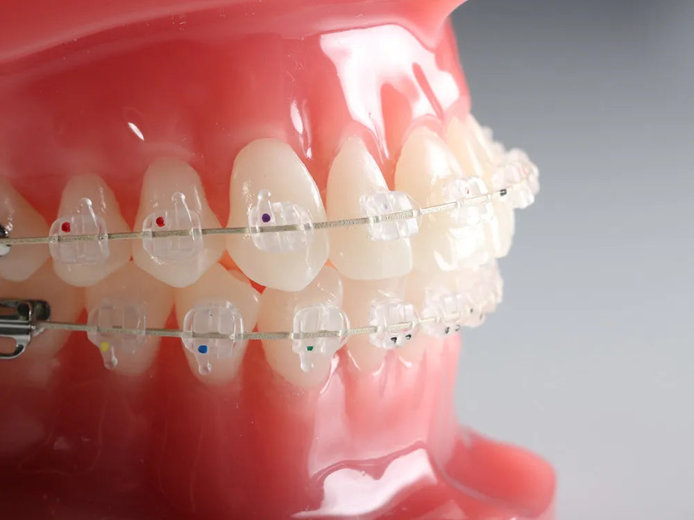 Axim Ceramic Brackets